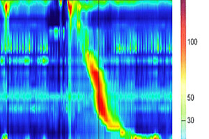 High resolution esophageal manometry